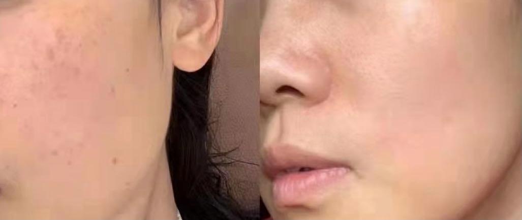 美白祛斑到底能祛斑不反弹吗?这事儿我得跟你唠明白 美白祛斑到底能祛斑不反弹吗?这事儿我得跟你唠明白